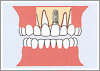 インプラント治療1
