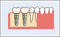 インプラント治療2