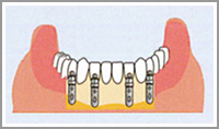 インプラント治療3