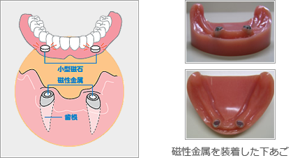 マグフィット（磁石式入れ歯）